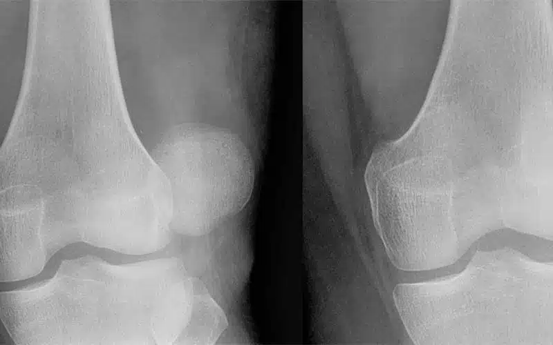 Problemas graves de rodilla bilateral – Hombre de 56 años